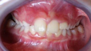 crossbite