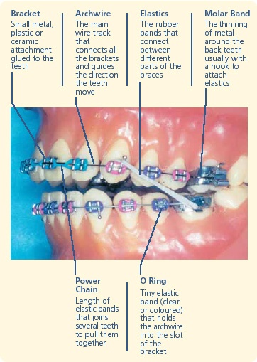 Braces Diagram Pic