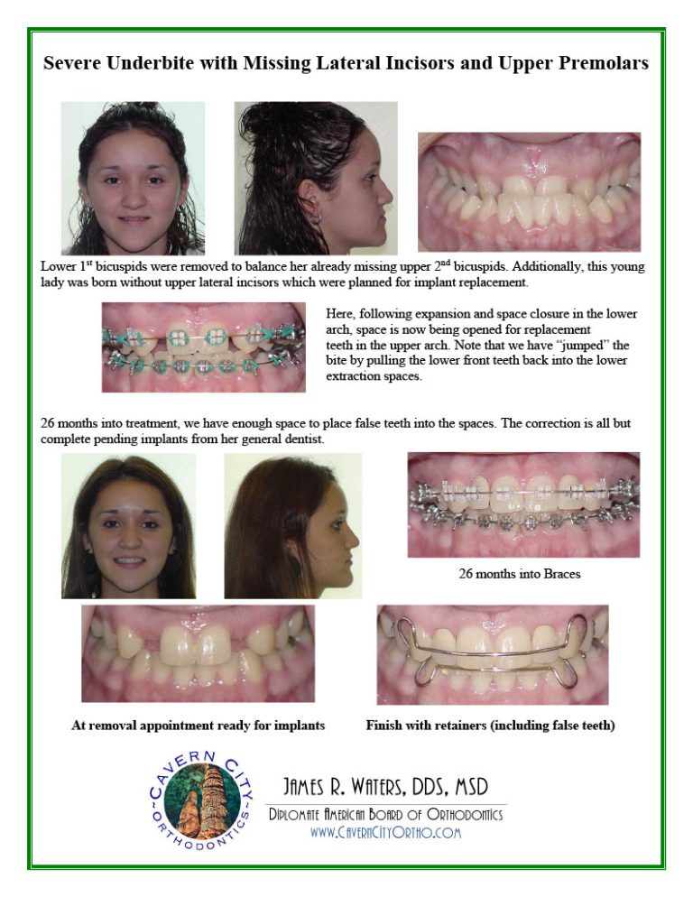 SmileGallery_AdolescentTreatment1024_11