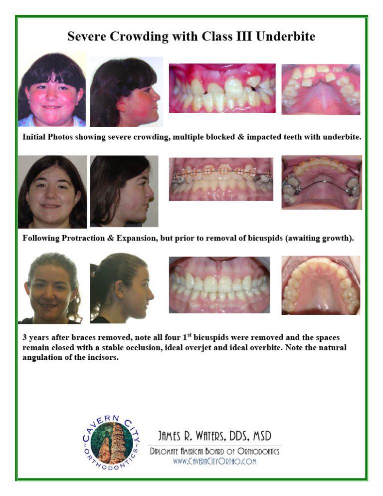 SmileGallery_AdolescentTreatment1024_17