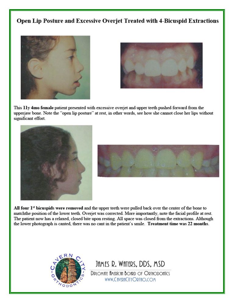 SmileGallery_AdolescentTreatment1024_20
