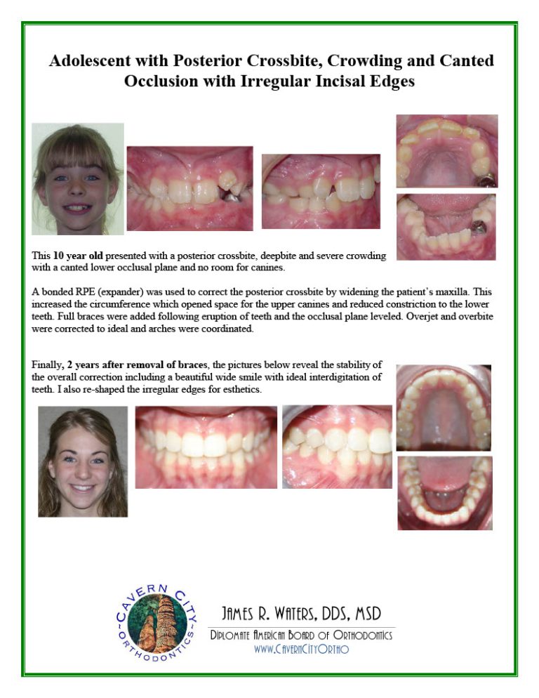 SmileGallery_AdolescentTreatment1024_26
